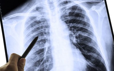 Don’t Overlook These Other Occupational Respiratory Illnesses